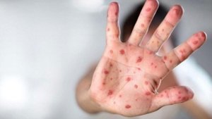 dunya-saglik-orgutu-mpox-virusu-icin-ilk-tani-testini-onayladi-S2lK3ThW.jpg