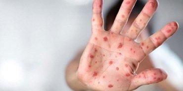 dunya-saglik-orgutu-mpox-virusu-icin-ilk-tani-testini-onayladi-S2lK3ThW.jpg