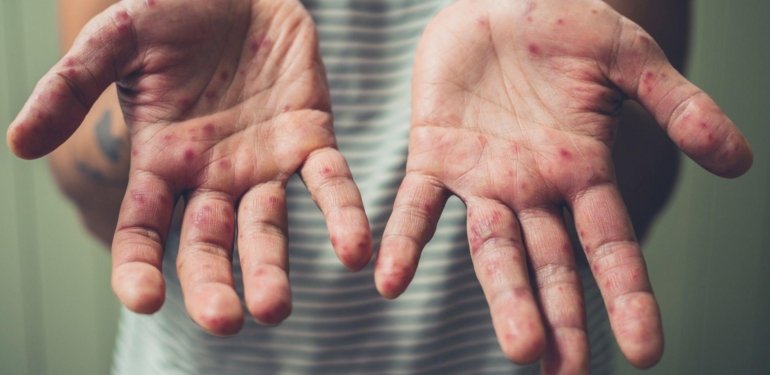 Kızamık Vakaları ve Aşılamanın Durumu: 2023 Raporu